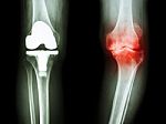 Film X-ray Knee Of Osteoarthritis Knee Patient And Artificial Joint Stock Photo