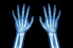 Film X-ray Normal Both Hands Of Child Stock Photo