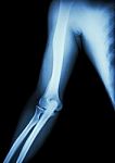 Film X-ray Of Normal Arm , Elbow And Forearm ( Black Background ) Stock Photo