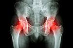 Film X-ray Pelvis And Arthritis Both Hip Stock Photo