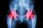 Film X-ray Pelvis And Arthritis Both Hip Stock Photo