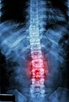 Film X-ray T-l Spine(thoracic-lumbar Spine) Show : Human's Thoracic-lumbar Spine And Inflammation At Lumbar Spine Stock Photo
