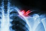 Fracture Left Clavicle Stock Photo