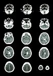 Hemorrhagic Stroke .  Ct Scan (computed Tomography) Of Brain ( C Stock Photo