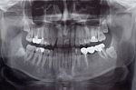 Human Teeth, X-ray Stock Photo