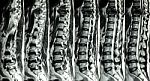 Mri Of Lumbar & Thoracic Spine : Show Fracture Of Thoracic Spine And Compress Spinal Cord ( Myelopathy ) Stock Photo