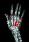 Multiple Fracture At Index,little Finger,metacarpal Bone Stock Photo