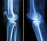 Normal Knee ( Left Image ) And Osteoarthritis Knee ( Right Image ) ( Lateral View ) Stock Photo