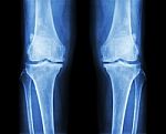 Osteoarthritis Both Knee .  Film X-ray Ap ( Anterior - Posterior ) Of Knee Show Narrow Joint Space , Osteophyte ( Spur ) , Subcondral Sclerosis Stock Photo