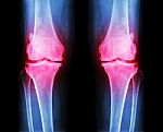Osteoarthritis Both Knee .  Film X-ray Ap ( Anterior - Posterior ) Of Knee Show Narrow Joint Space , Osteophyte ( Spur ) , Subcondral Sclerosis Stock Photo