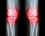 Osteoarthritis Both Knee .  Film X-ray Ap ( Anterior - Posterior ) Of Knee Show Narrow Joint Space , Osteophyte ( Spur ) , Subcondral Sclerosis Stock Photo