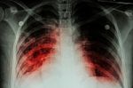 Pulmonary Tuberculosis ( Tb )  :  Chest X-ray Show Alveolar Infiltration At Both Lung Due To Mycobacterium Tuberculosis Infectionpulmonary Tuberculosis ( Tb )  :  Chest X-ray Show Alveolar Infiltration At Both Lung Due To Mycobacterium Tuberculosis Infecti Stock Photo