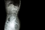 Spondylosis , Spondylolisthesis  ( Film X-ray Lumbo - Sacral Spine Show Spine Collapse , Decrease In Disc Space , Bony Spur Formation ) ( Side , Lateral View ) And Blank Area At Right Side Stock Photo