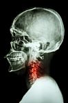 X-ray Asian Skull And Cervical Spine And Neck Pain Stock Photo