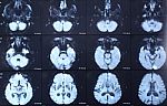 X-ray Brain Film Stock Photo