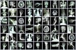 X-ray Multiple Part Of Adult And Child And Disease ( Pulmonary Tuberculosis Stroke Kidney Stone Osteoarthritis Bone Fracture Bowel Obstruction Spondylosis Spondylolisthesis Scoliosis Brain Tumor Etc) Stock Photo
